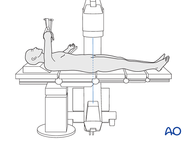Supine patient position on a radiolucent table and the C-arm positioned for an AP view of the proximal femur