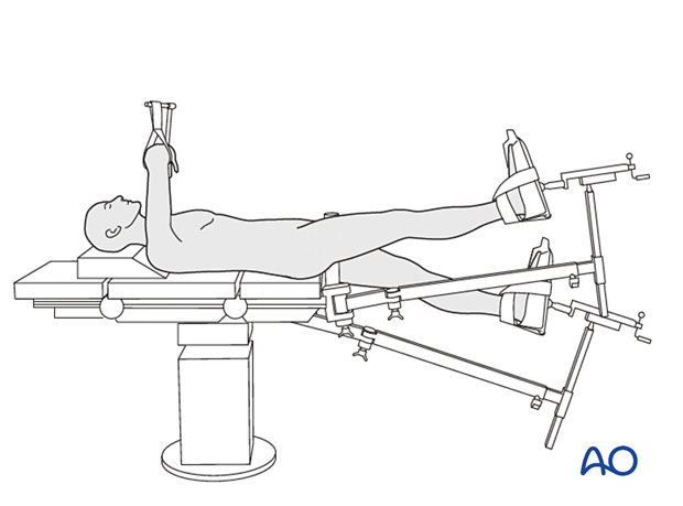 Supine patient position on a fracture table with the legs in a scissors position for surgical treatment of proximal femoral fractures
