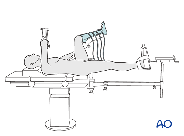 Supine patient position on a fracture table with the contralateral leg in a leg holder and VTE pump for surgical treatment of proximal femoral fractures