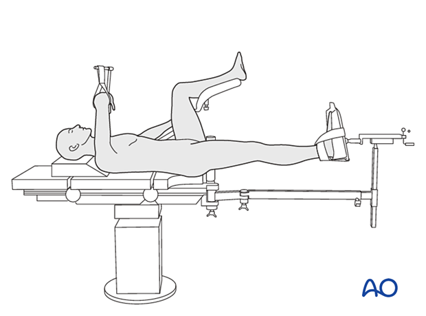 Patient supine on a fracture table with the contralateral leg in a leg holder for surgical treament of the proximal femur