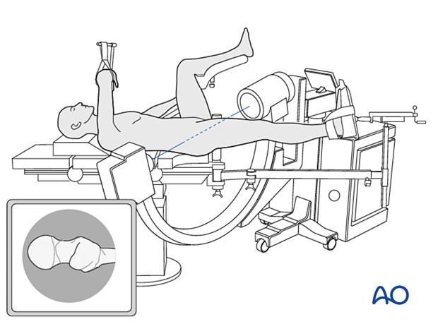 Patient in supine position on a fracture table with C-arm positioned for an axial view