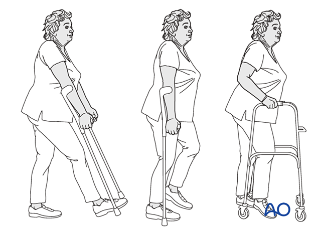 Patient mobilization with weight bearing as tolerated and walking aids after nonoperative treatment of proximal femoral fractures