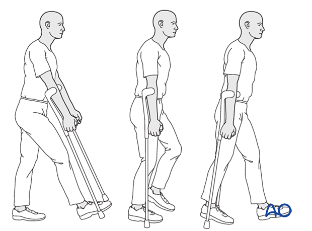 Weight bearing as tolerated with walking aids after treatment of proximal femoral fractures