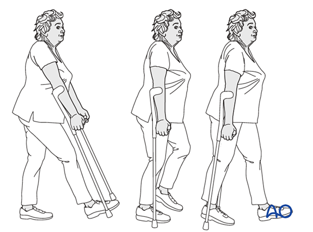 Weight bearing as tolerated with walking aids after treatment of proximal femoral fractures