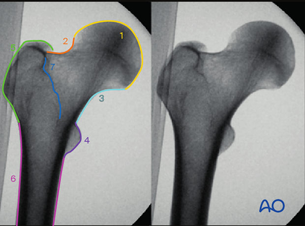 AP view of the proximal femur with radiographic landmarks