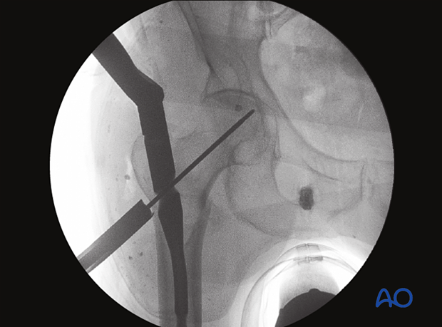 AP view of the proximal femur to confirm correct guide-wire insertion in the femoral neck and head for intramedullary nailing