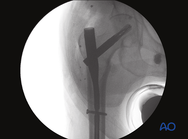 AP view of the proximal femur to confirm correct position of a short intramedullary nail
