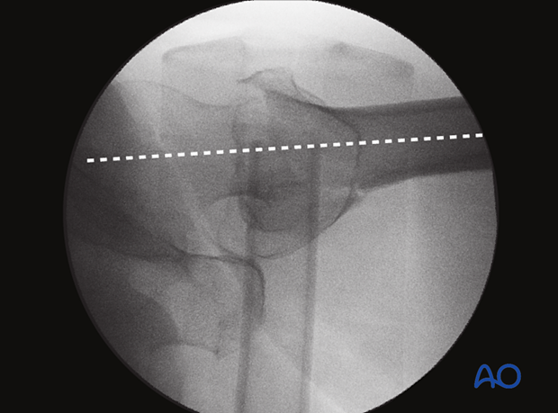 In an optimal axial view, the head-neck and femoral shaft axis are aligned