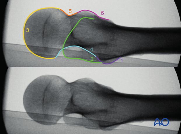 Anatomical landmarks and radiological lines on an axial view of the proximal femur