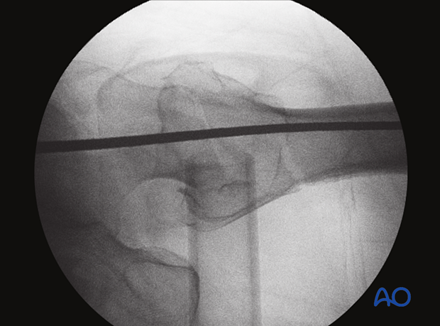 Axial view of the proximal femur with a guide wire positioned for nail insertion