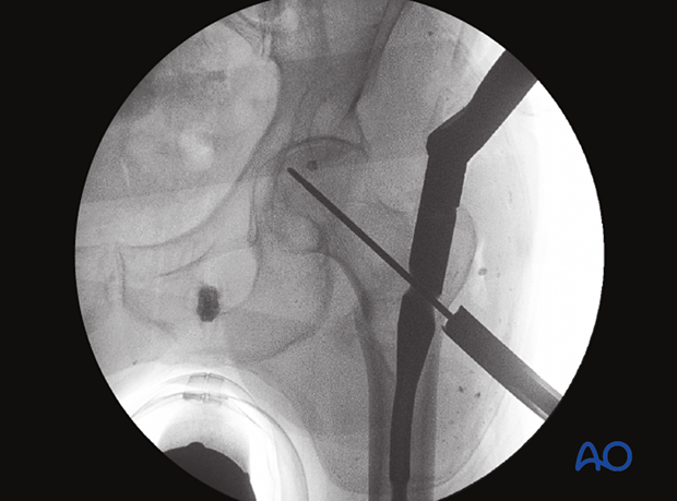 AP view of the proximal femur to confirm correct guide-wire insertion for the helical blade (center of the head) of an intramedullary nail