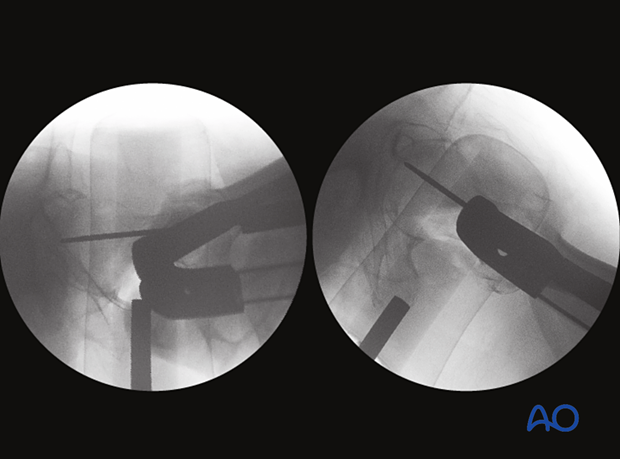 Axial and lateral view of the proximal femur with guide-wire inserted for the helical blade of an intramedullary nail