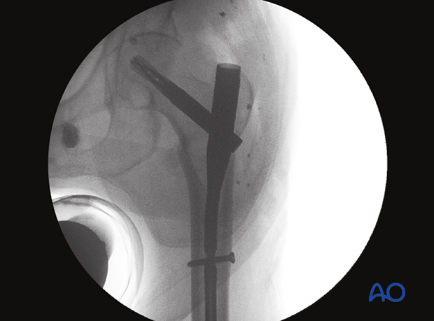 AP view of the proximal femur confirming correct nail position