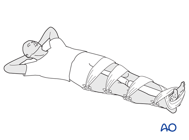 Splinting the fractured leg to the uninjured leg with padding placed between the two legs