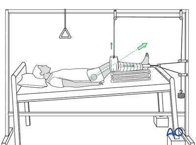 Fracture management with minimal resources for Basicervical femoral ...