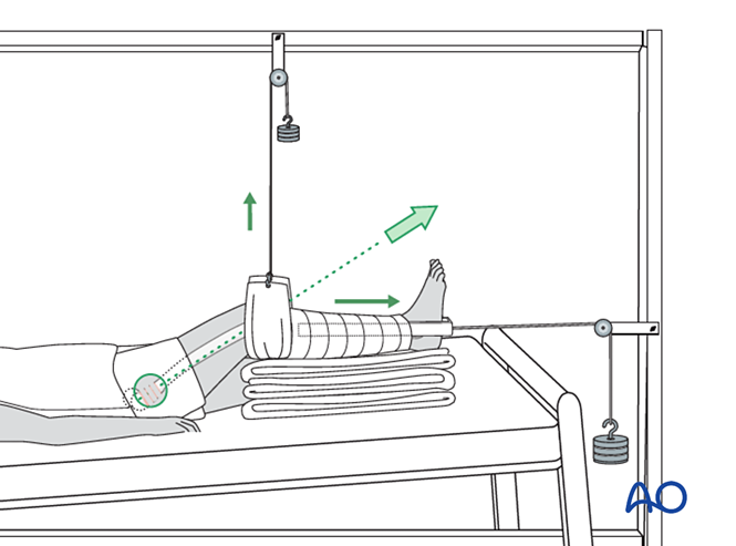 Fracture management with minimal resources for Basicervical femoral ...