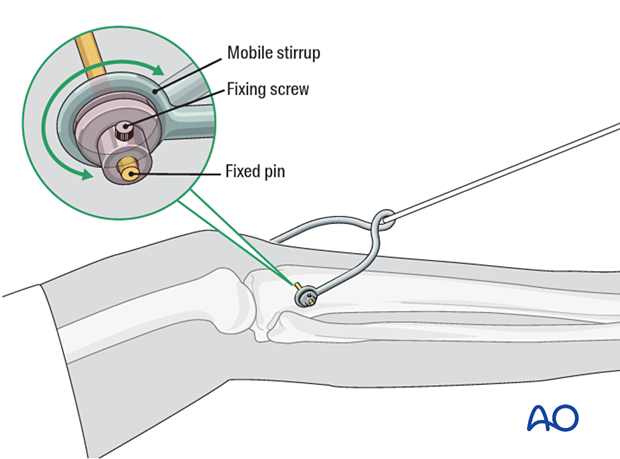 Stirrup and pin in proximal tibia for skeletal traction of the leg