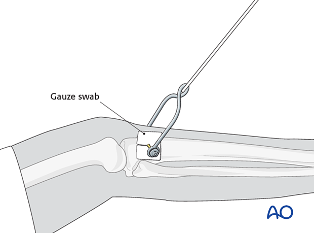 Slit gauze swab as dressing around the pin of the skeletal traction device