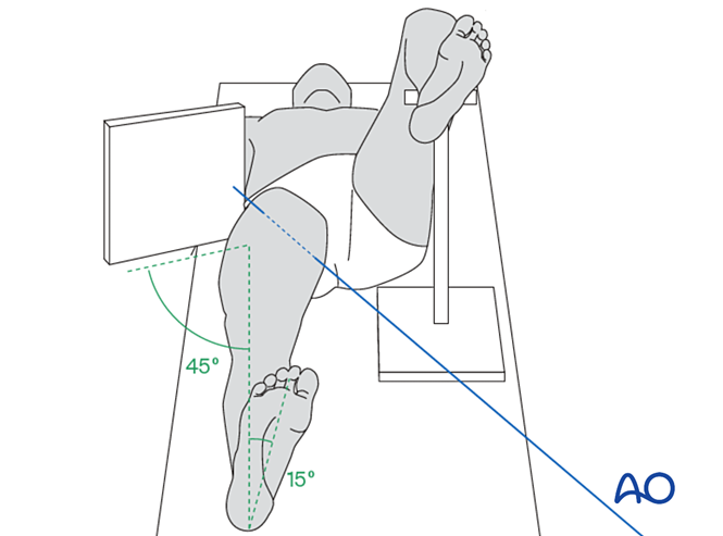 Traction Internal Rotation View Assessment of patients with a proximal femoral fracture