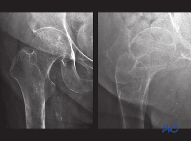 Undisplaced trochanteric fracture of the proximal femur, also known as occult hip fracture, is often not well visible in an x-ray.
