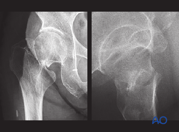 Displaced femoral neck fractures show disruption of the medial and lateral cortical line in the AP x-ray. In the lateral view, abnormal anteversion or retroversion should be recognized.