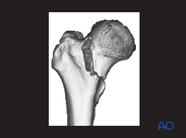 3-D CT image of a femoral neck fracture
