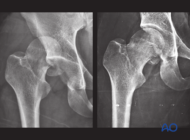 X-rays of a femoral head split fracture with hip dislocation (left) and after hip reduction (right)