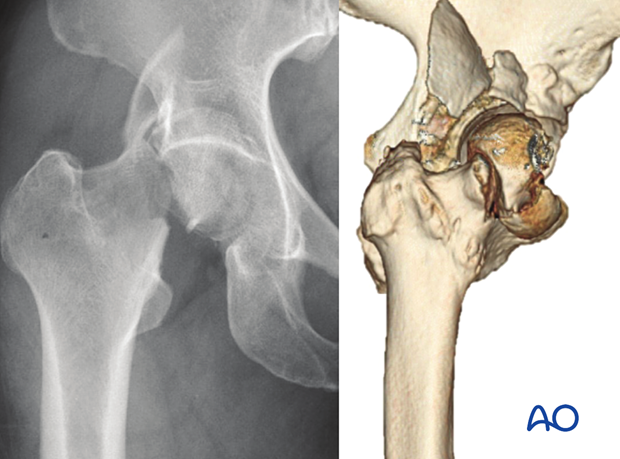 X-ray and CT image of a femoral neck and head fracture combined with a posterior wall fracture and hip dislocation
