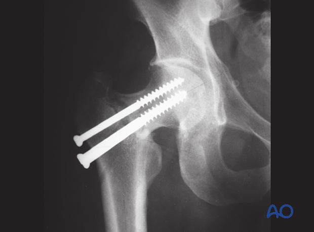 Follow-up x-ray of a basicervical femoral neck fracture fixed with cancellous screws with the proximal fragment displaced into varus deformity 