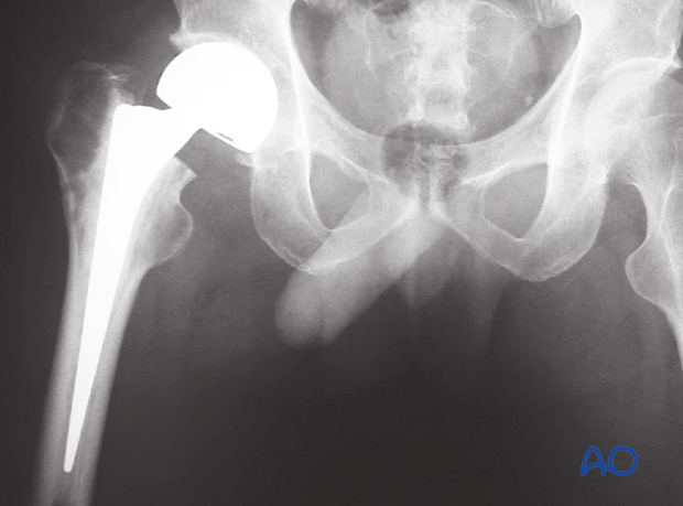 AP x-ray of a hemiarthroplasty of the hip joint