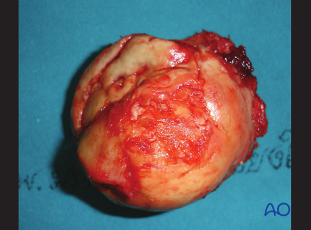 Removed femoral head showing partial collapse of the articular cartilage