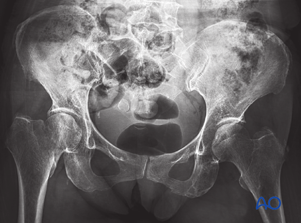 AP x-ray of a transcervical femoral neck fracture in a patient with osteoporosis