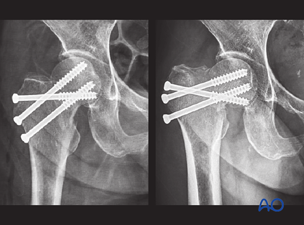 Postoperative and follow-up x-rays of a transcervical femoral neck fracture showing displacement and collapse into varus after 6 weeks