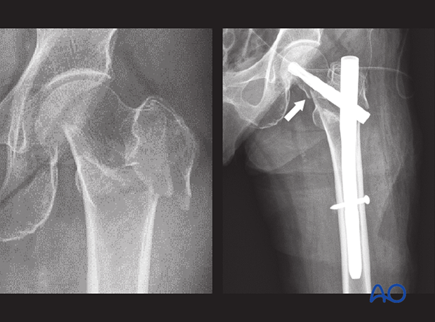 X-rays of an elderly patient with the apparent trochanteric fracture treated with a short nail fixation.
