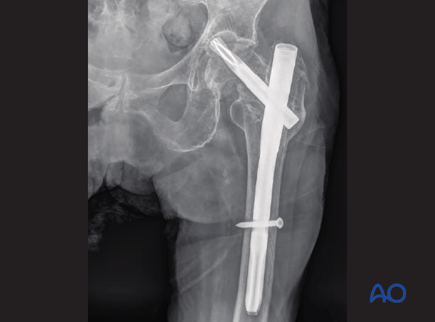 One-year follow-up x-rays of an elderly patient with the apparent trochanteric fracture treated with a short nail fixation.