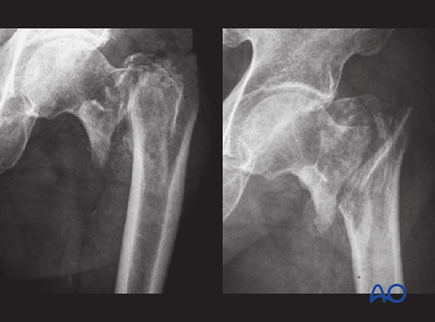 X-rays of an irreducible intertrochanteric fracture