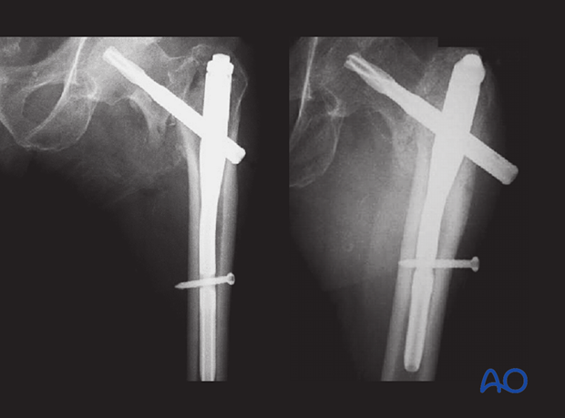 Postoperative and follow-up x-ray of an intertrochanteric fracture treated with nail fixation, the latter showing severe collapse