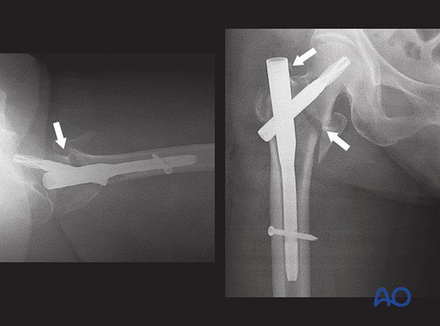X-rays of a trochanteric fracture with unreduced valgus deformity and medial gap, treated with nail fixation