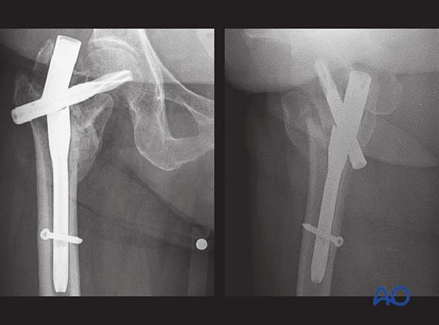 Metal failure of a short trochanteric nail due to the lack of sliding and medial support