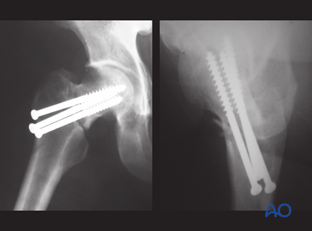 Postoperative AP and lateral x-rays of a basicervical femoral neck fracture fixed with cancellous screws