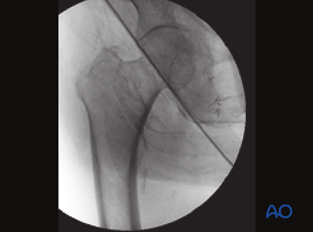 AP view of a reduced pertrochanteric fracture