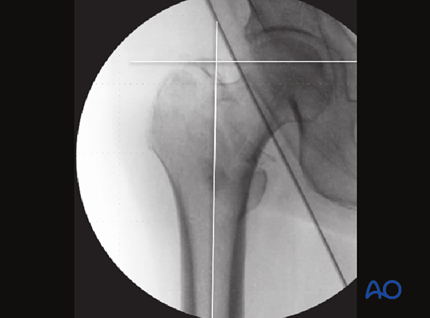 To identify a varus angulation, draw a line along the axis of the proximal femur and a perpendicular line on the level of the tip of the greater trochanter on the AP image. This line should run through the center of the femoral head.