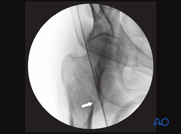 AP view of a trochanteric fracture with a medial opening (medial cortical line disruption; arrow) and valgus deformity