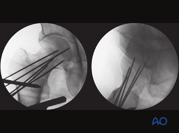 AP and axial view of a reduced femoral neck fracture temporarily stabilized with K-wires