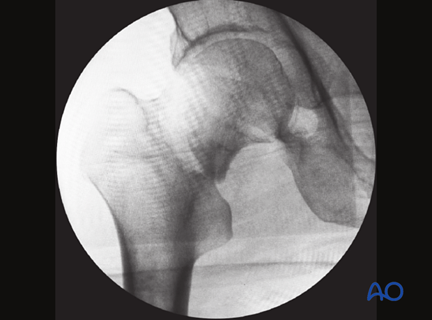 AP view of a femoral neck fracture showing a shortening step in the medial cortex and a gap in the lateral cortex