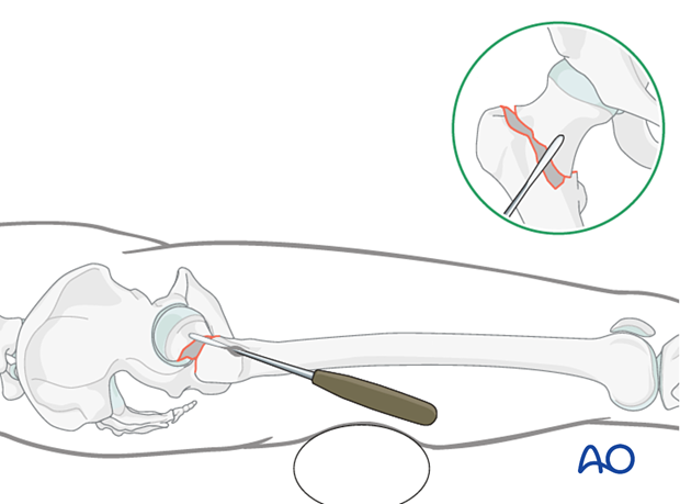 Reduction of a flexion deformity of a trochanteric fracture with an elevator and a support underneath the femoral shaft
