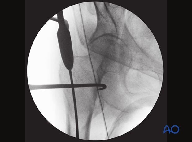 Intraoperative view of a trochanteric fracture reduced and held with a bone hook 