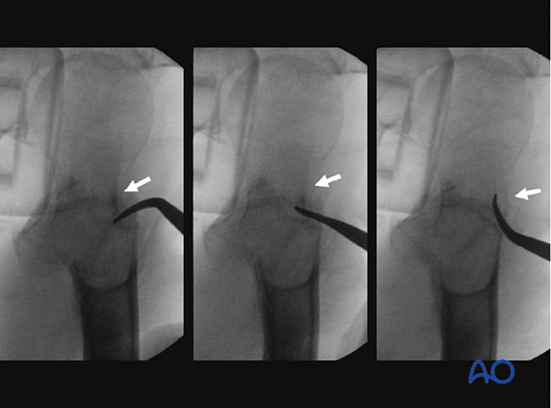 Hook leverage technique for a reduction of a step-off or neck-down deformity of a trochanteric fracture