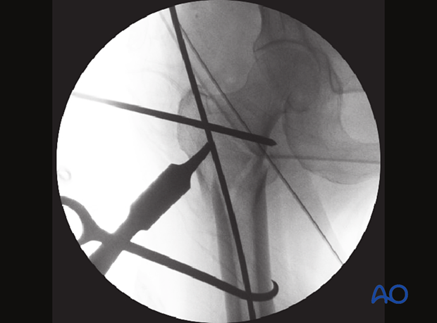 AP view of an intertrochanteric fracture reduction with a trochanteric joystick, a Hohmann retractor, and a bone hook