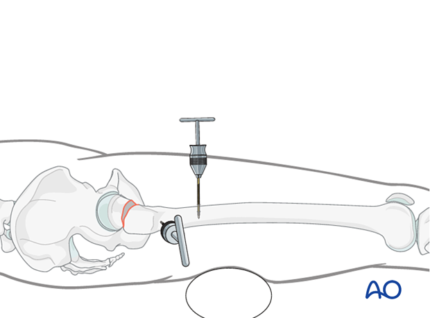 Reduction of a femoral neck fracture with two Schanz screws and a support underneath the femoral shaft
